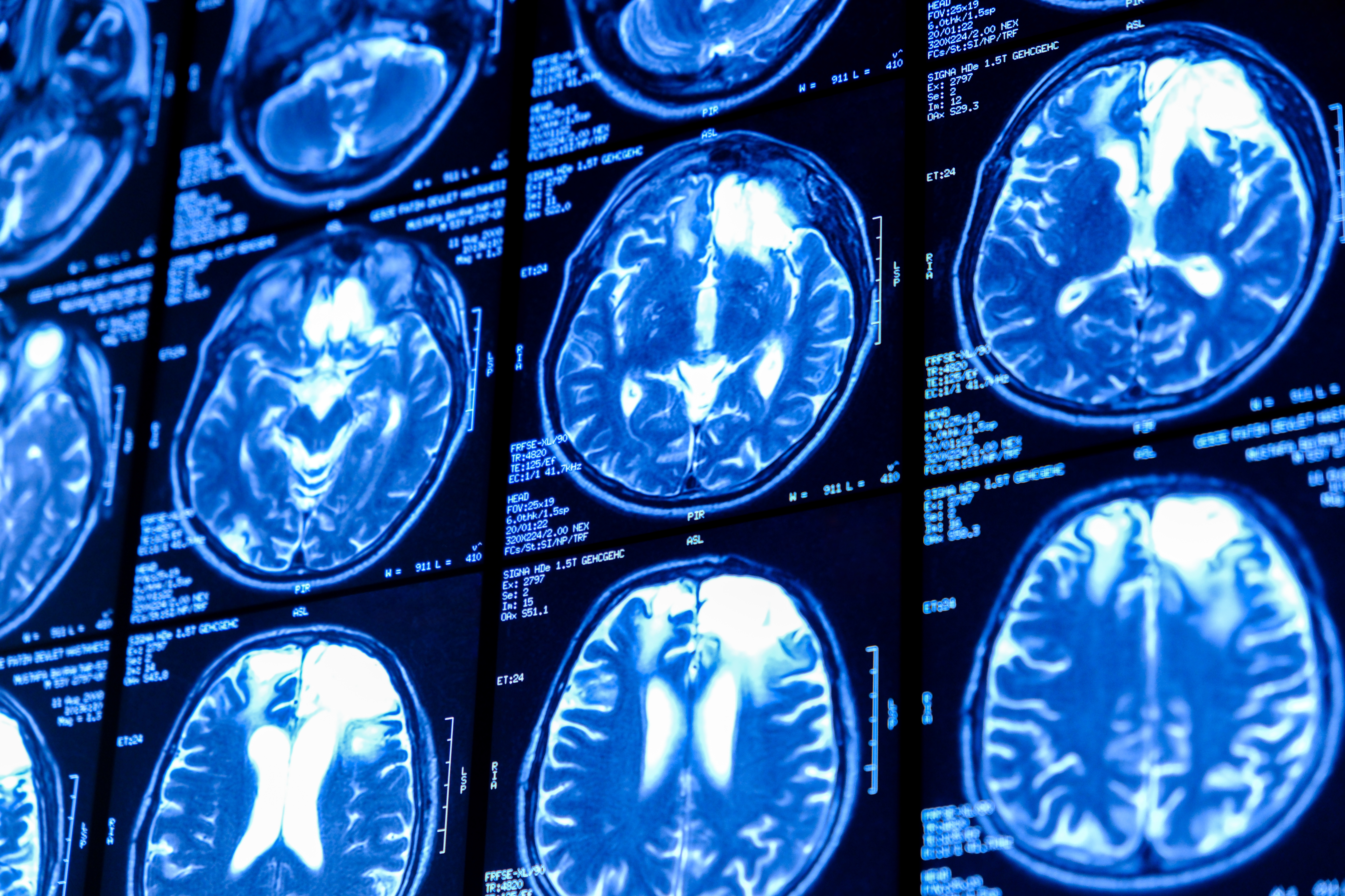 Real-time IONM data displayed in operating room.